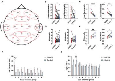 Interictal EEG and ECG for SUDEP Risk Assessment: A Retrospective Multicenter Cohort Study